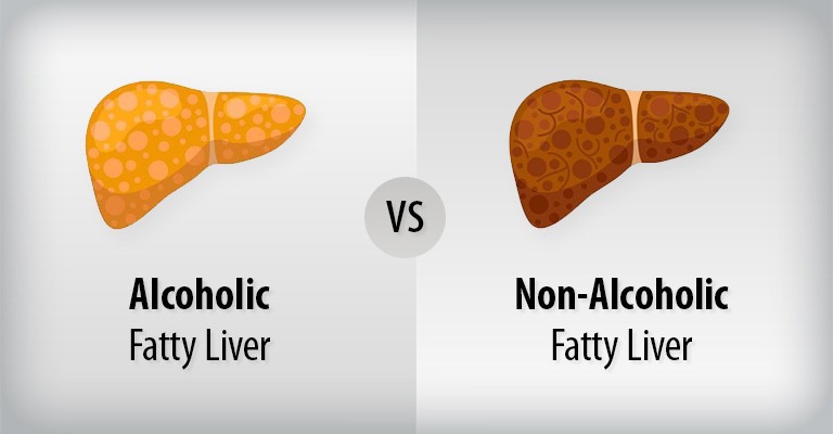 Alcoholic Fatty Liver Diseases (AFLD) and Non-Alcoholic Fatty Liver Diseases (NAFLD) 